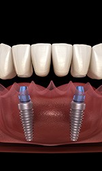 Digital image of implant dentures