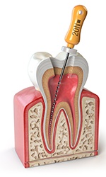 Illustration of file being used for root canal treatment