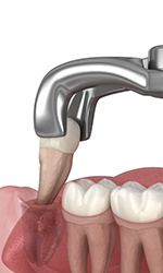 Illustration of tooth being extracted with forceps