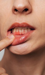 Woman with gum irritation