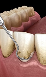 Illustration of scaling and root planing